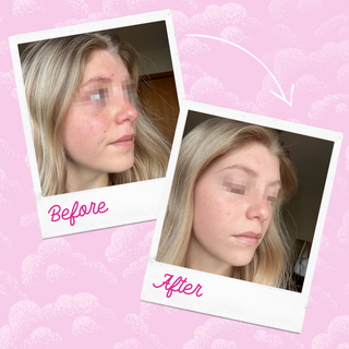 Silver Infused MakeUp Eraser - Acne Skin